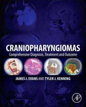 Craniopharyngiomas: Comprehensive Diagnosis, Treatment and Outcome de James J. Evans