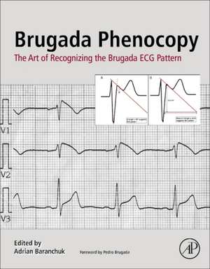 Brugada Phenocopy: The Art of Recognizing the Brugada ECG Pattern de Adrian Baranchuk