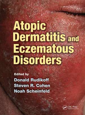 Atopic Dermatitis and Eczematous Disorders de Donald Rudikoff