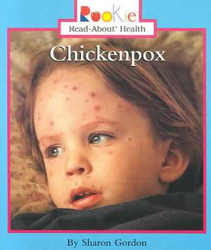 Chickenpox de Sharon Gordon