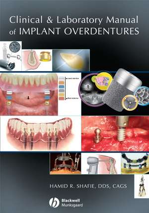 Clinical and Laboratory Manual of Implant Overdentures de M Shafie