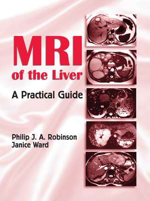 MRI of the Liver: A Practical Guide de Philip J. A. Robinson