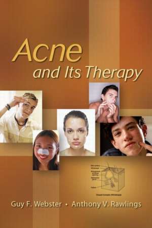 Acne and Its Therapy de Guy F. Webster