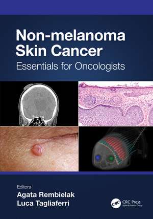 Non-melanoma Skin Cancer: Essentials for Oncologists de Agata Rembielak