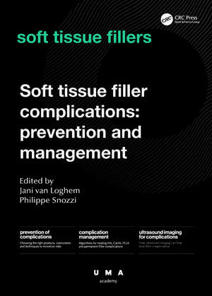 Soft Tissue Filler Complications: Prevention and Management de Jani van Loghem