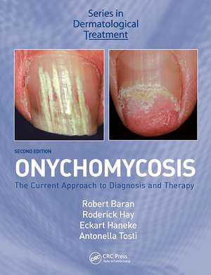 Onychomycosis: The Current Approach to Diagnosis and Therapy de Robert Baran