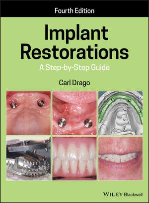 Implant Restorations – A Step–by–Step Guide 4e de C Drago