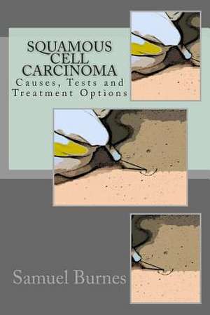 Squamous Cell Carcinoma de Samuel Burnes Ma