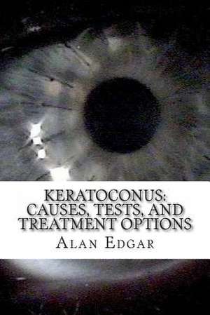 Keratoconus de Alan Edgar Ma