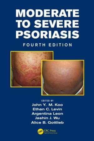 Moderate to Severe Psoriasis de John Koo