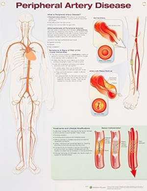 PERIPHERAL ARTERY DISEASE LAMINATE CHART de Tbd