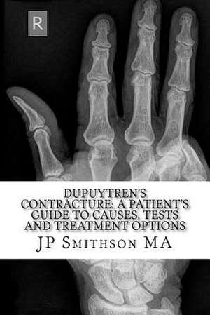 Dupuytren's Contracture de J. P. Smithson Ma