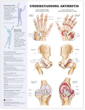 Understanding Arthritis Anatomical Chart de Anatomical Chart Company