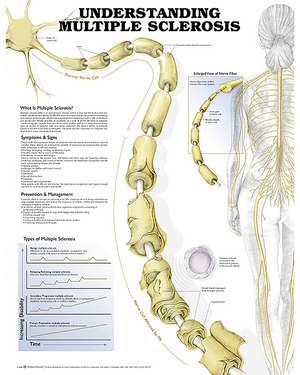 Understanding Multiple Sclerosis Anatomical Chart de Anatomical Chart Company 