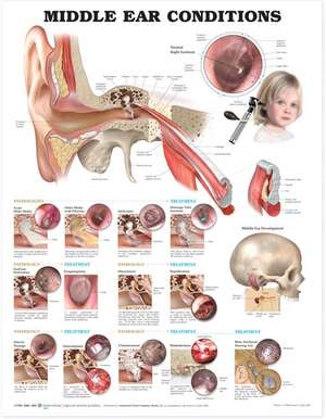 Middle Ear Conditions Anatomical Chart de Anatomical Chart Company