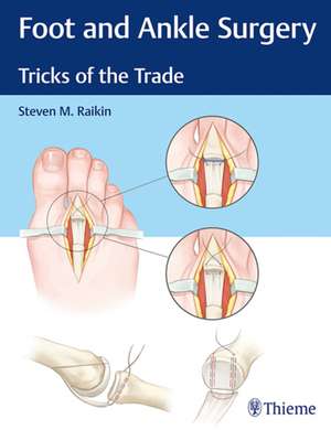 Foot and Ankle Surgery – Tricks of the Trade de Steven M. Raikin