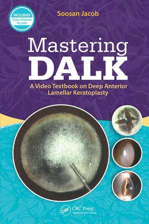 Mastering DALK: A Video Textbook on Deep Anterior Lamellar Keratoplasty de Soosan Jacob