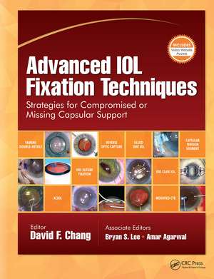 Advanced IOL Fixation Techniques: Strategies for Compromised or Missing Capsular Support de David F. Chang