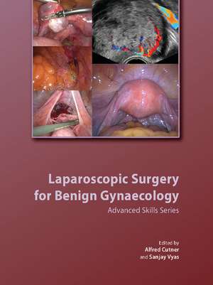 Laparoscopic Surgery for Benign Gynaecology Hardback with DVDs de Alfred Cutner