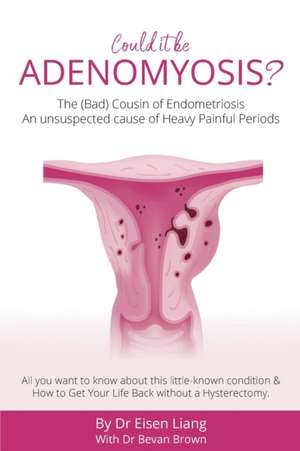 Adenomyosis -The Bad Cousin of Endometriosis de Bevan Brown