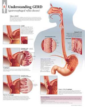 Understanding Gerd Chart: Laminated Wall Chart de Scientific Publishing