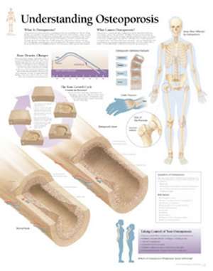 Understanding Osteoporosis Chart: Laminated Wall Chart de Scientific Publishing