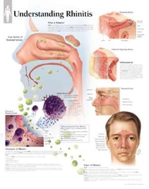 Understanding Rhinitis Chart: Laminated Wall Chart de Scientific Publishing