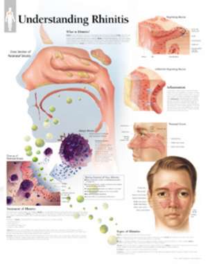 Understanding Rhinitis Laminated Poster de Scientific Publishing