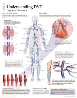 Understanding Dvt Chart: Wall Chart de various