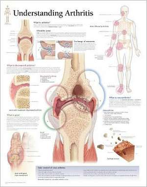 Understanding Arthritis Chart: Wall Chart de various