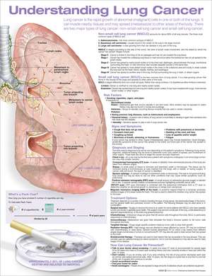 Understanding Lung Cancer Anatomical Chart de Anatomical Chart Company