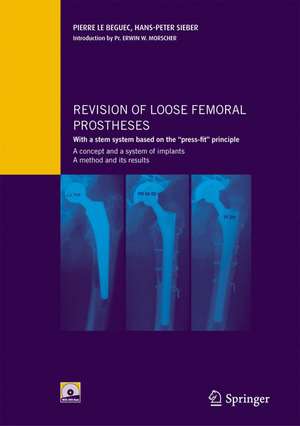 Revision of loose femoral prostheses with a stem system based on the "press-fit" principle: A concept and its system of implants, a method and its results de Pierre Le Béguec