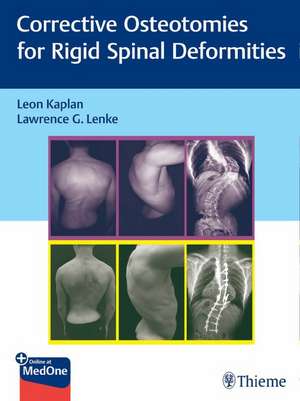 Corrective Osteotomies for Rigid Spinal Deformities de Leon Kaplan