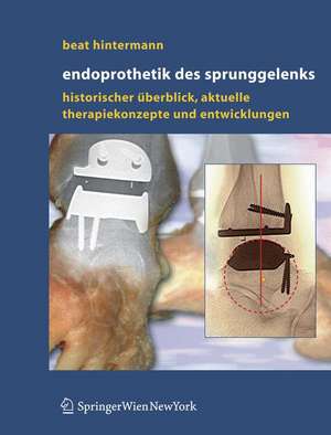 Endoprothetik des Sprunggelenks: Historischer Überblick, aktuelle Therapiekonzepte und Entwicklungen de Beat Hintermann