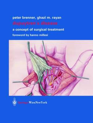 Dupuytren’s Disease: A Concept of Surgical Treatment de Peter Brenner