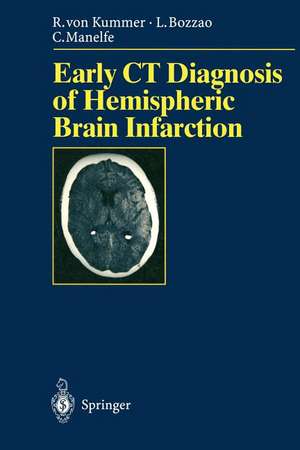 Early CT Diagnosis of Hemispheric Brain Infarction de S. Bastianello