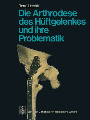 Die Arthrodese des Hüftgelenkes und ihre Problematik de R. Liechti