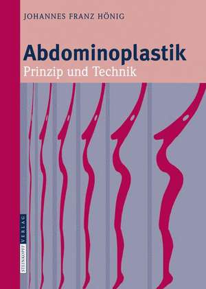 Abdominoplastik: Prinzip und Technik de Johannes-Franz Hönig