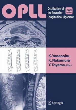 OPLL: Ossification of the Posterior Longitudinal Ligament de K. Yonenobu