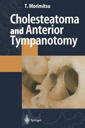 Cholesteatoma and Anterior Tympanotomy de Tamotsu Morimitsu