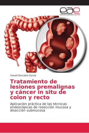 Tratamiento de lesiones premalignas y cáncer in situ de colon y recto de Yesael Descalzo García