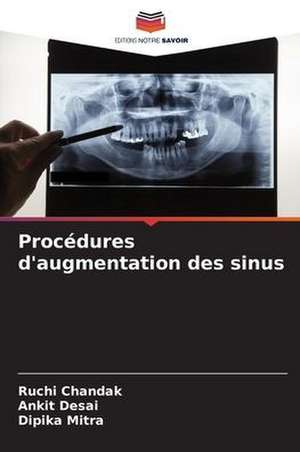 Procédures d'augmentation des sinus de Ruchi Chandak