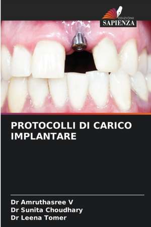 PROTOCOLLI DI CARICO IMPLANTARE de Amruthasree V