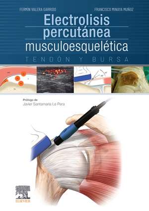 Electrolisis percutánea musculoesquelética : tendón y bursa de Fermín Valera Garrido