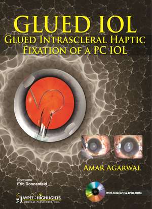 GLUED IOL: Glued Intrascleral Haptic Fixation of a PC IOL de Amar Agarwal