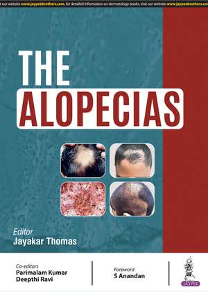 The Alopecias de Jayakar Thomas