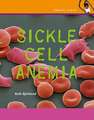 Sickle Cell Anemia