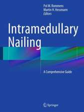 Intramedullary Nailing: A Comprehensive Guide