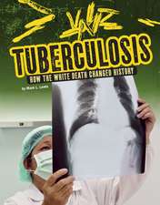 Tuberculosis