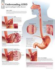 Understanding Gerd Chart: Laminated Wall Chart